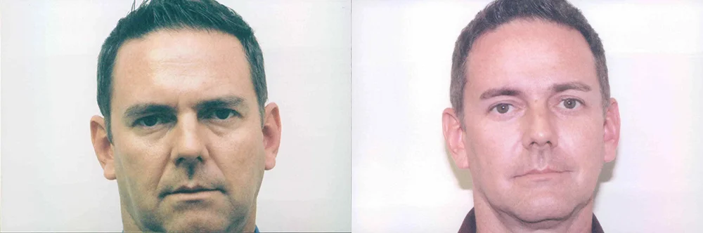 Real patient results in Newport Beach, CA Performed by Boris M. Ackerman MD