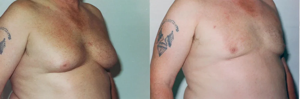 Real patient results in Newport Beach, CA Performed by Boris M. Ackerman MD