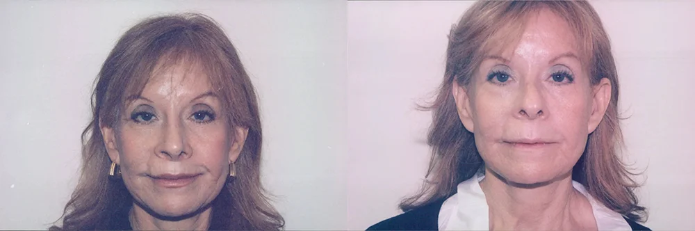 Real patient results in Newport Beach, CA Performed by Boris M. Ackerman MD