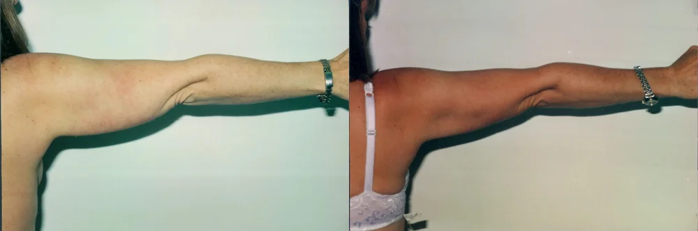 Real patient results in Newport Beach, CA Performed by Boris M. Ackerman MD