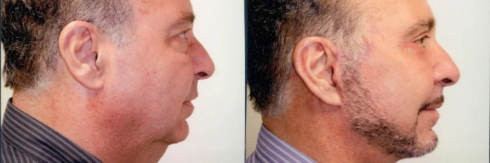Real patient results in Newport Beach, CA Performed by Boris M. Ackerman MD
