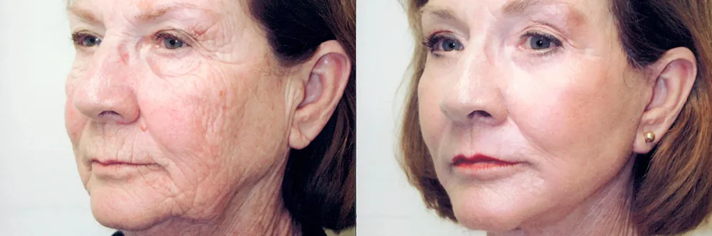 Real patient results in Newport Beach, CA Performed by Boris M. Ackerman MD