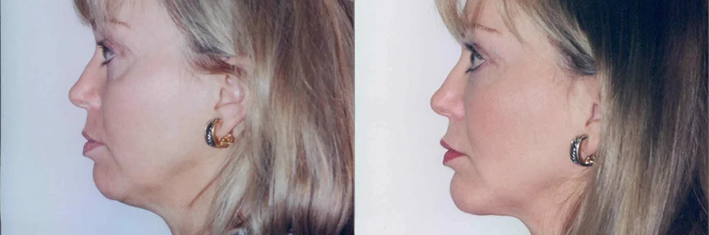 Real patient results in Newport Beach, CA Performed by Boris M. Ackerman MD