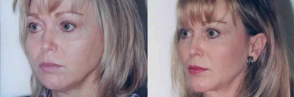 Real patient results in Newport Beach, CA Performed by Boris M. Ackerman MD