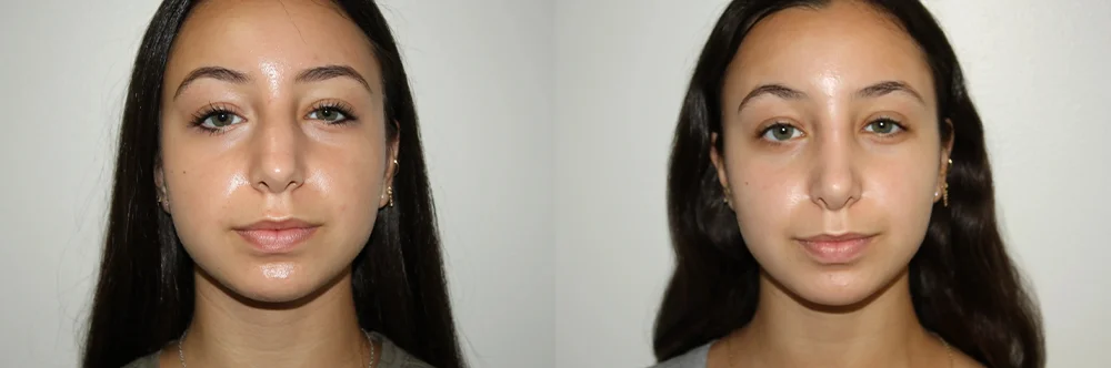 Real patient results in Newport Beach, CA Performed by Boris M. Ackerman MD