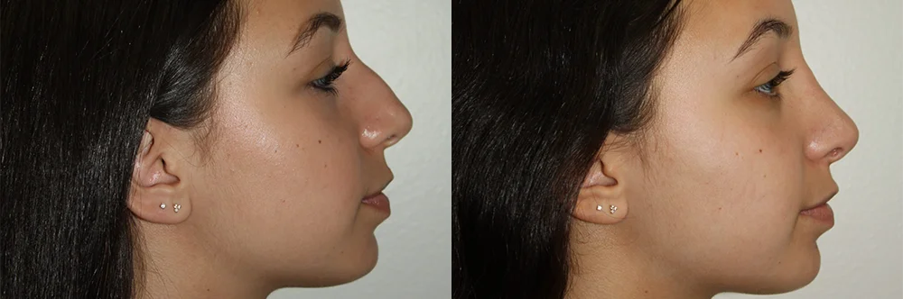 Real patient results in Newport Beach, CA Performed by Boris M. Ackerman MD