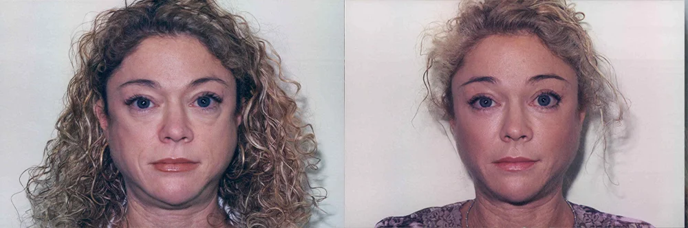 Real patient results in Newport Beach, CA Performed by Boris M. Ackerman MD
