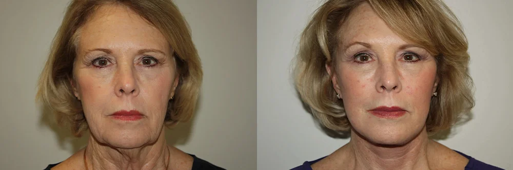 Real patient results in Newport Beach, CA Performed by Boris M. Ackerman MD