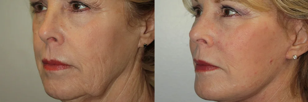 Real patient results in Newport Beach, CA Performed by Boris M. Ackerman MD