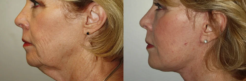 Real patient results in Newport Beach, CA Performed by Boris M. Ackerman MD