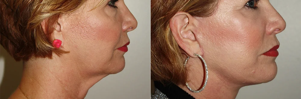 Real patient results in Newport Beach, CA Performed by Boris M. Ackerman MD