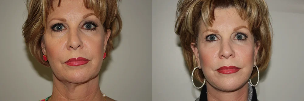 Real patient results in Newport Beach, CA Performed by Boris M. Ackerman MD