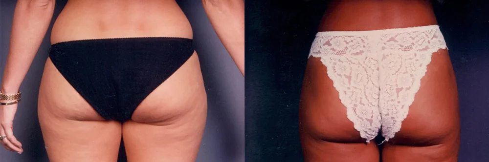 Real patient results in Newport Beach, CA Performed by Boris M. Ackerman MD