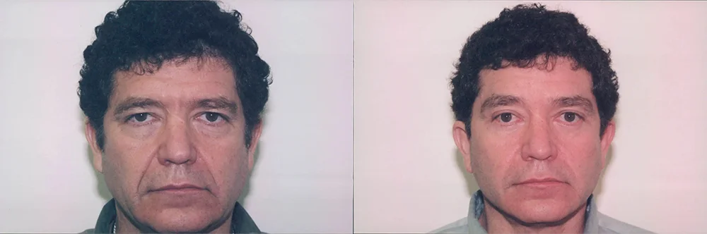 Real patient results in Newport Beach, CA Performed by Boris M. Ackerman MD