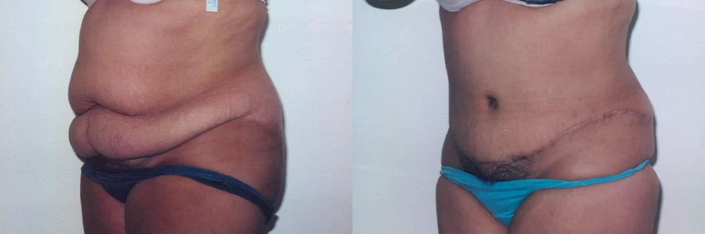 Real patient results in Newport Beach, CA Performed by Boris M. Ackerman MD