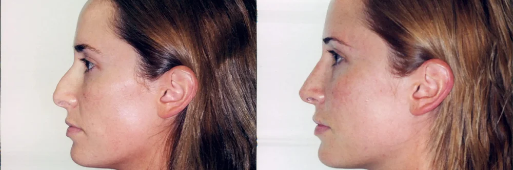 Real patient results in Newport Beach, CA Performed by Boris M. Ackerman MD