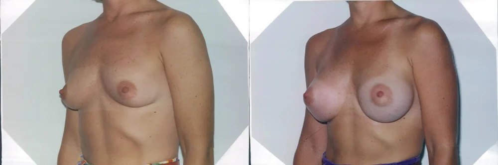 Real patient results in Newport Beach, CA Performed by Boris M. Ackerman MD
