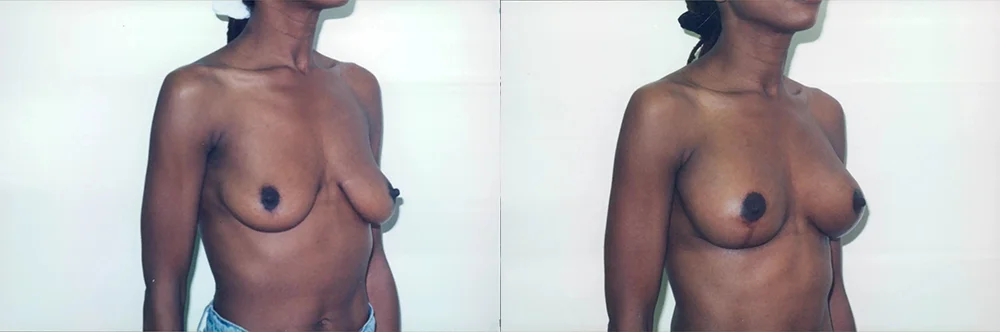 Real patient results in Newport Beach, CA Performed by Boris M. Ackerman MD