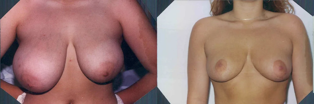 Real patient results in Newport Beach, CA Performed by Boris M. Ackerman MD