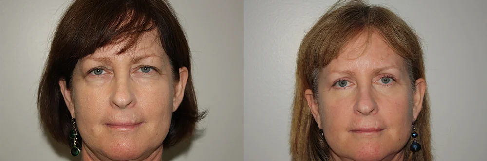 Real patient results in Newport Beach, CA Performed by Boris M. Ackerman MD