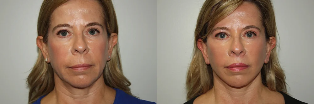 Real patient results in Newport Beach, CA Performed by Boris M. Ackerman MD