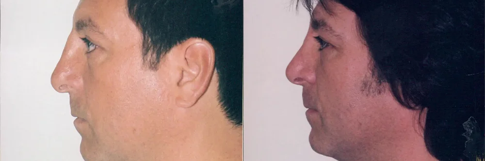 Real patient results in Newport Beach, CA Performed by Boris M. Ackerman MD