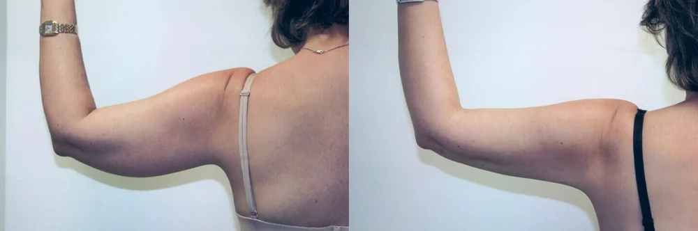 Real patient results in Newport Beach, CA Performed by Boris M. Ackerman MD