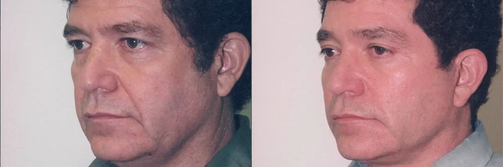 Real patient results in Newport Beach, CA Performed by Boris M. Ackerman MD