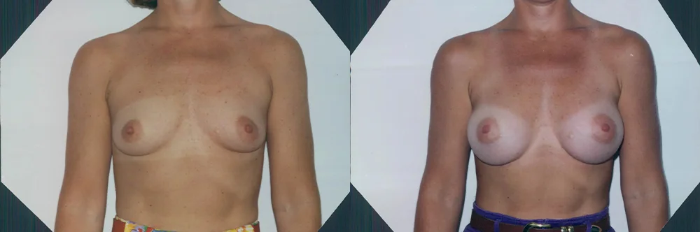 Real patient results in Newport Beach, CA Performed by Boris M. Ackerman MD