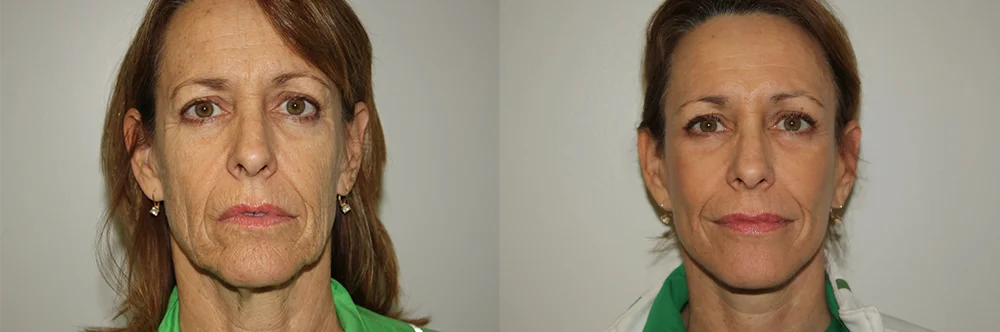 Real patient results in Newport Beach, CA Performed by Boris M. Ackerman MD