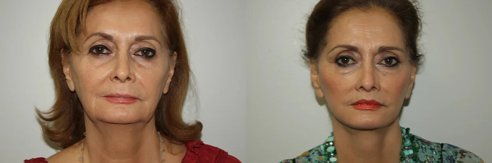 Real patient results in Newport Beach, CA Performed by Boris M. Ackerman MD