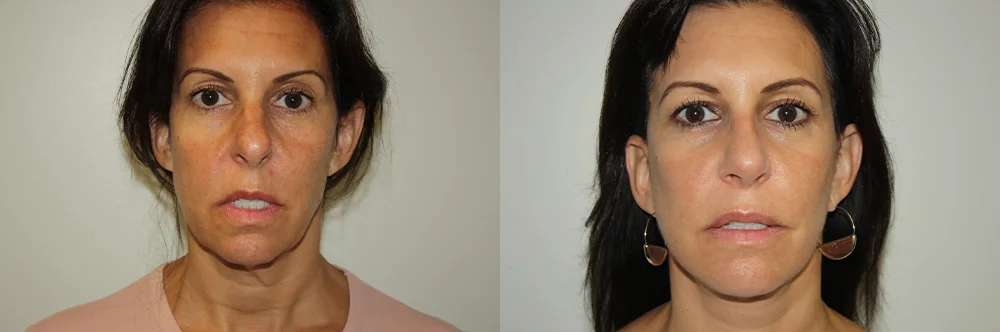 Real patient results in Newport Beach, CA Performed by Boris M. Ackerman MD