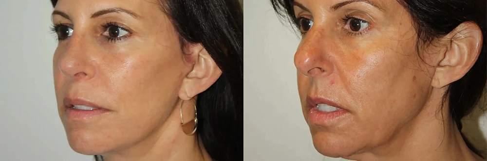 Real patient results in Newport Beach, CA Performed by Boris M. Ackerman MD