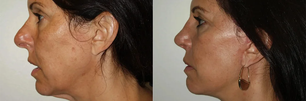 Real patient results in Newport Beach, CA Performed by Boris M. Ackerman MD
