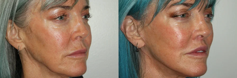 Real patient results in Newport Beach, CA Performed by Boris M. Ackerman MD