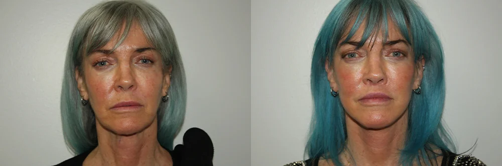 Real patient results in Newport Beach, CA Performed by Boris M. Ackerman MD