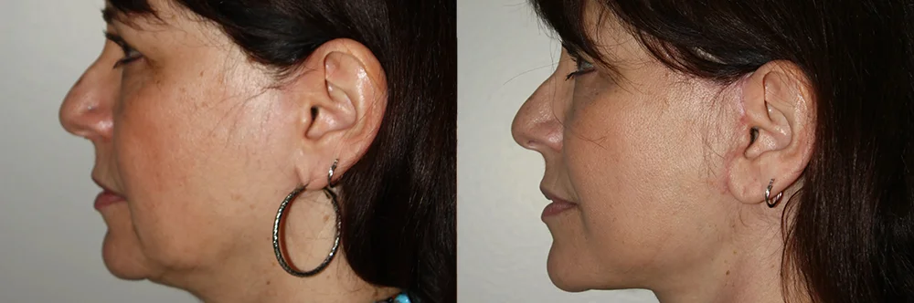 Real patient results in Newport Beach, CA Performed by Boris M. Ackerman MD