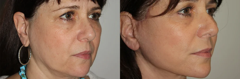 Real patient results in Newport Beach, CA Performed by Boris M. Ackerman MD