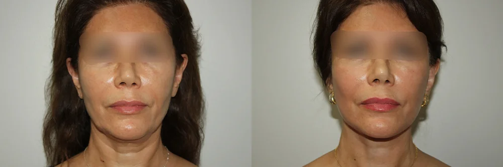 Real patient results in Newport Beach, CA Performed by Boris M. Ackerman MD