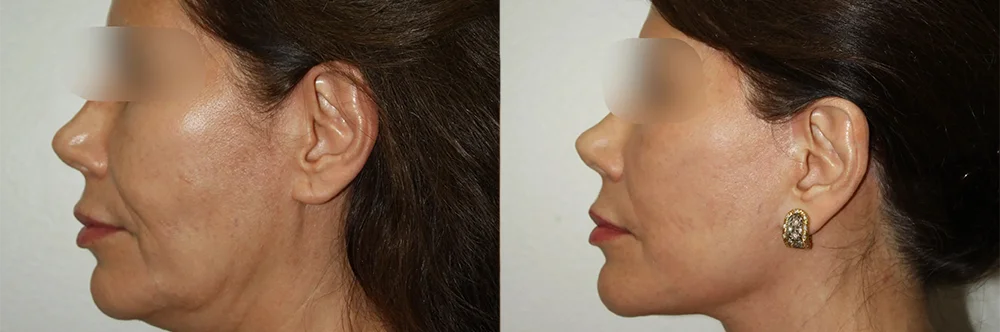 Real patient results in Newport Beach, CA Performed by Boris M. Ackerman MD
