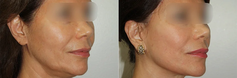 Real patient results in Newport Beach, CA Performed by Boris M. Ackerman MD