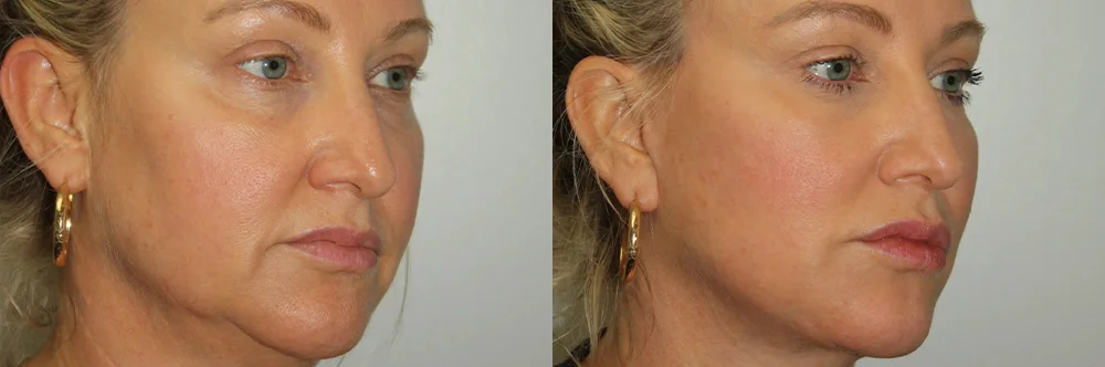Real patient results in Newport Beach, CA Performed by Boris M. Ackerman MD