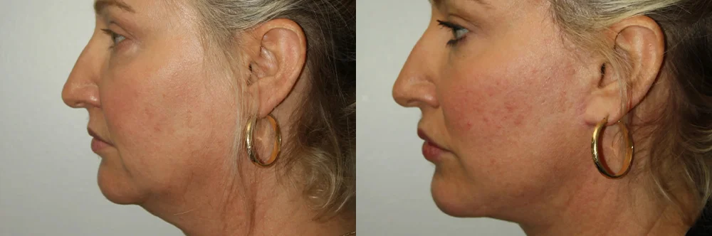 Real patient results in Newport Beach, CA Performed by Boris M. Ackerman MD