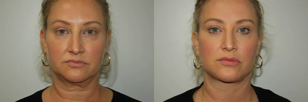 Real patient results in Newport Beach, CA Performed by Boris M. Ackerman MD