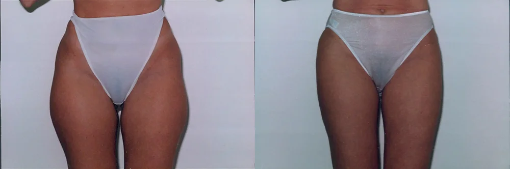 Real patient results in Newport Beach, CA Performed by Boris M. Ackerman MD