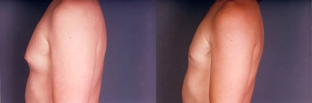 Real patient results in Newport Beach, CA Performed by Boris M. Ackerman MD
