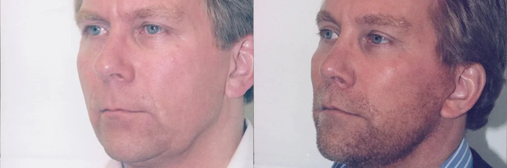 Real patient results in Newport Beach, CA Performed by Boris M. Ackerman MD