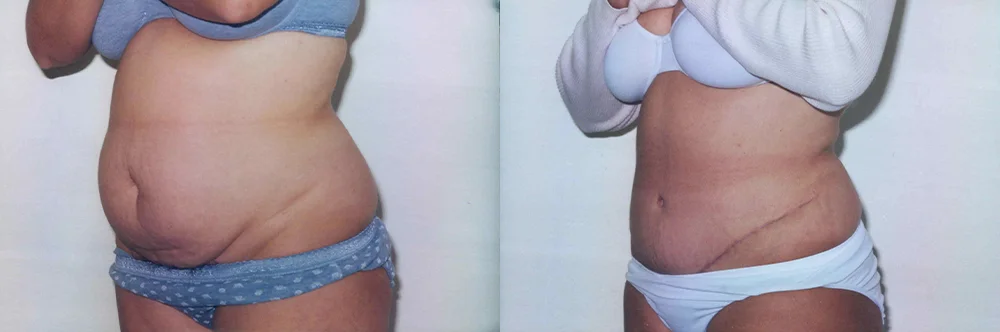 Real patient results in Newport Beach, CA Performed by Boris M. Ackerman MD