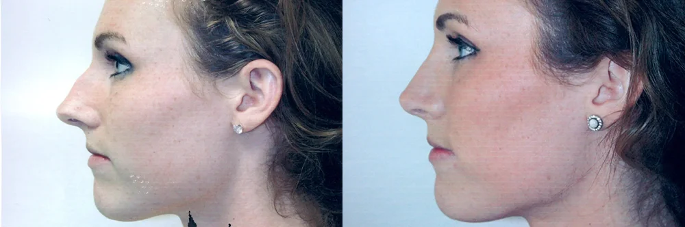 Real patient results in Newport Beach, CA Performed by Boris M. Ackerman MD