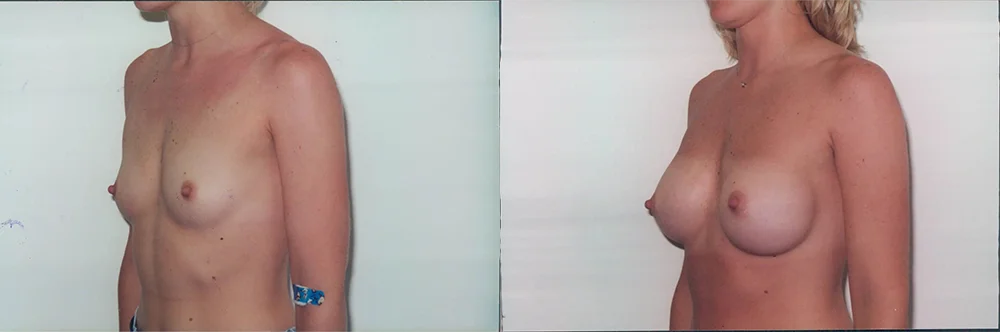 Real patient results in Newport Beach, CA Performed by Boris M. Ackerman MD